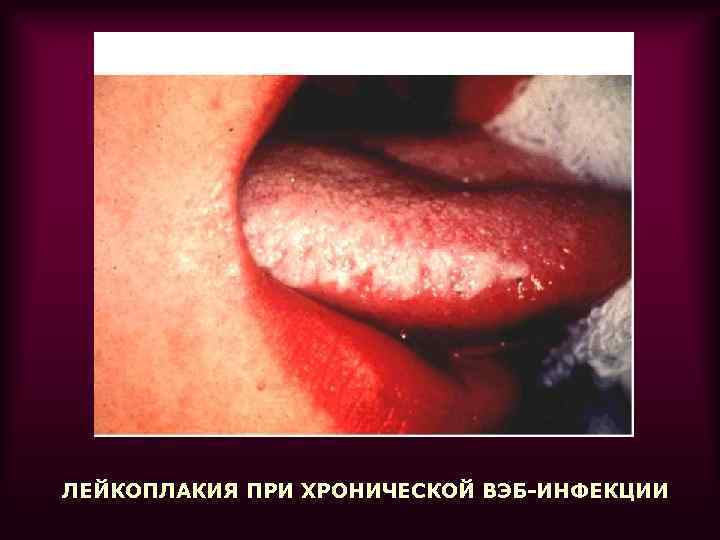 ЛЕЙКОПЛАКИЯ ПРИ ХРОНИЧЕСКОЙ ВЭБ-ИНФЕКЦИИ 