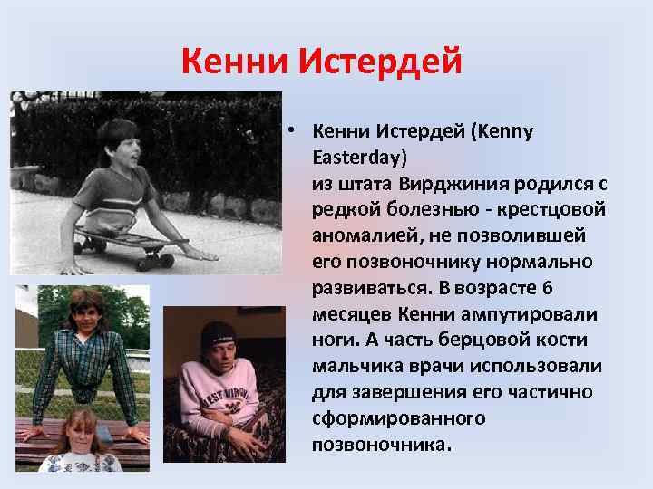 Кенни Истердей • Кенни Истердей (Kenny Easterday) из штата Вирджиния родился с редкой болезнью