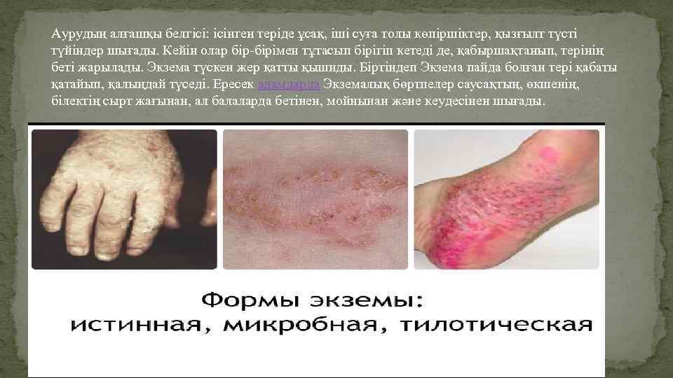 Аурудың алғашқы белгісі: ісінген теріде ұсақ, іші суға толы көпіршіктер, қызғылт түсті түйіндер шығады.