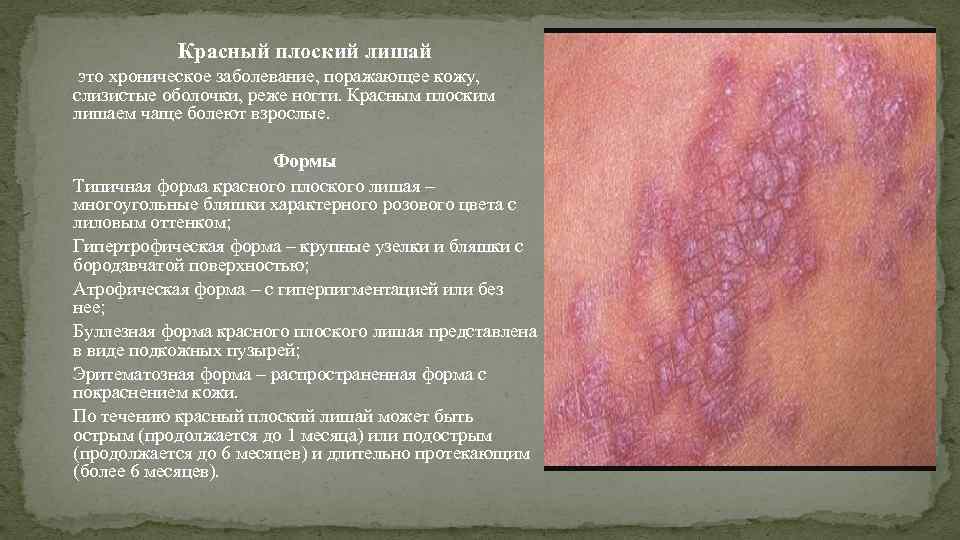 Красный плоский лишай это хроническое заболевание, поражающее кожу, слизистые оболочки, реже ногти. Красным плоским