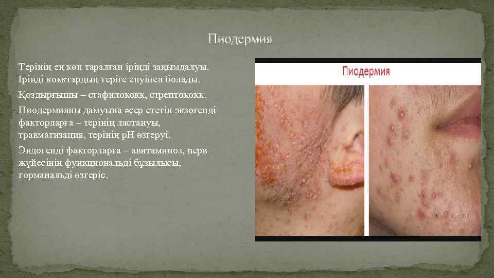 Пиодермия Терінің ең көп таралған іріңді зақымдалуы. Іріңді кокктардың теріге енуінен болады. Қоздырғышы –