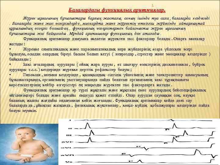 1 Балалардағы функциялық аритмиялар. Жүрек ырғағының бұзылыстары барлық жастағы, соның ішінде туа сала ,