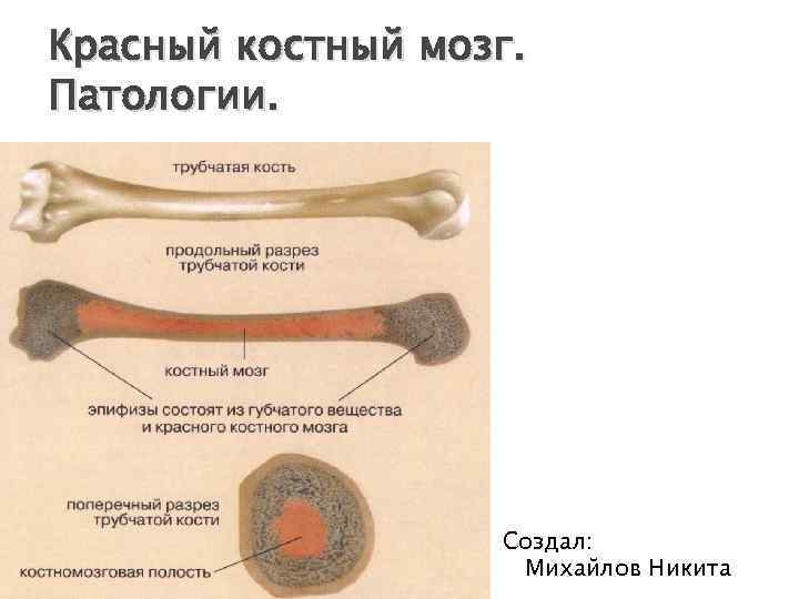 Красный костный мозг. Патологии. Создал: Михайлов Никита 