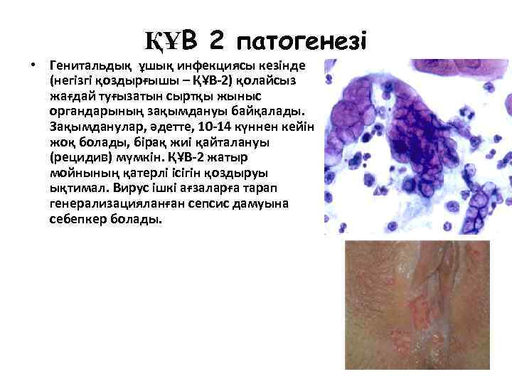 ҚҰВ 2 патогенезі • Генитальдық ұшық инфекциясы кезінде (негізгі қоздырғышы – ҚҰВ-2) қолайсыз жағдай
