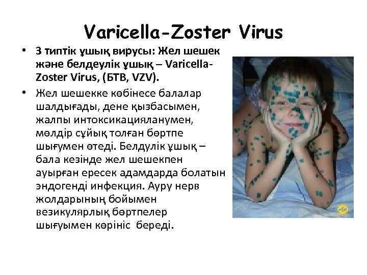 Varicella-Zoster Virus • 3 типтік ұшық вирусы: Жел шешек және белдеулік ұшық – Varicella.
