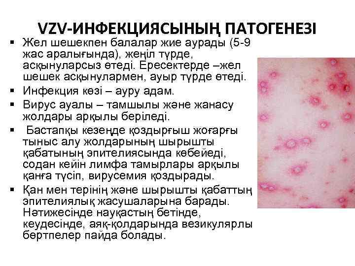 VZV-ИНФЕКЦИЯСЫНЫҢ ПАТОГЕНЕЗІ § Жел шешекпен балалар жие аурады (5 -9 жас аралығында), жеңіл түрде,