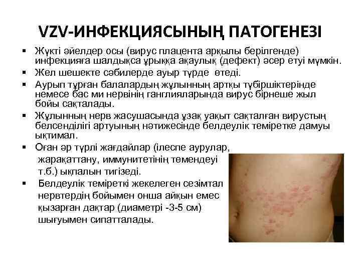 VZV-ИНФЕКЦИЯСЫНЫҢ ПАТОГЕНЕЗІ § Жүкті әйелдер осы (вирус плацента арқылы берілгенде) инфекцияға шалдықса ұрыққа ақаулық