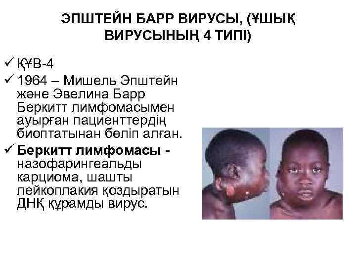 ЭПШТЕЙН БАРР ВИРУСЫ, (ҰШЫҚ ВИРУСЫНЫҢ 4 ТИПІ) ü ҚҰВ-4 ü 1964 – Мишель Эпштейн
