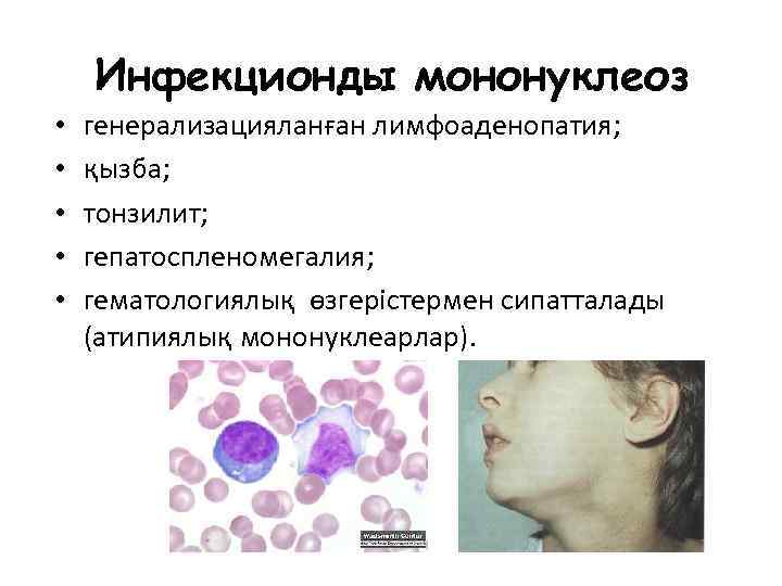 Инфекционды мононуклеоз • • • генерализацияланған лимфоаденопатия; қызба; тонзилит; гепатоспленомегалия; гематологиялық өзгерістермен сипатталады (атипиялық