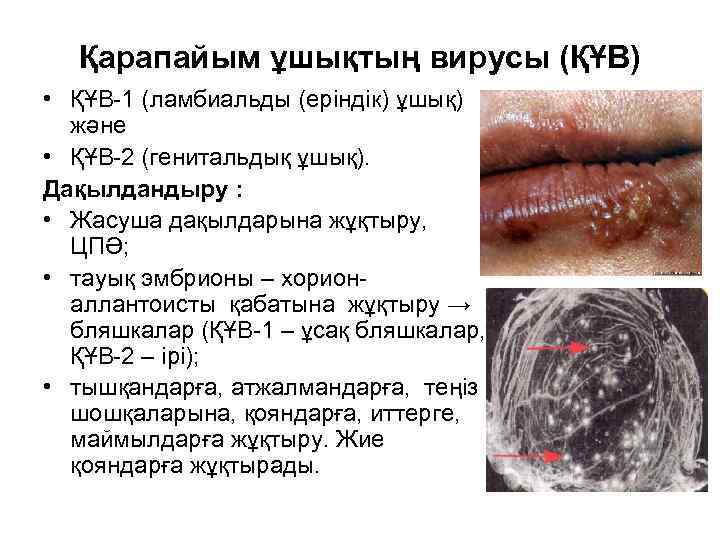 Қарапайым ұшықтың вирусы (ҚҰВ) • ҚҰВ-1 (ламбиальды (еріндік) ұшық) және • ҚҰВ-2 (генитальдық ұшық).