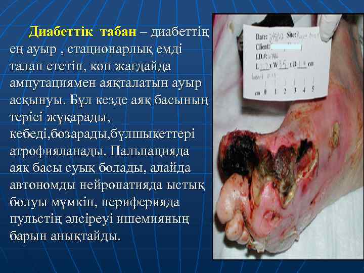 Диабеттік табан – диабеттің ең ауыр , стационарлық емді талап ететін, көп жағдайда ампутациямен