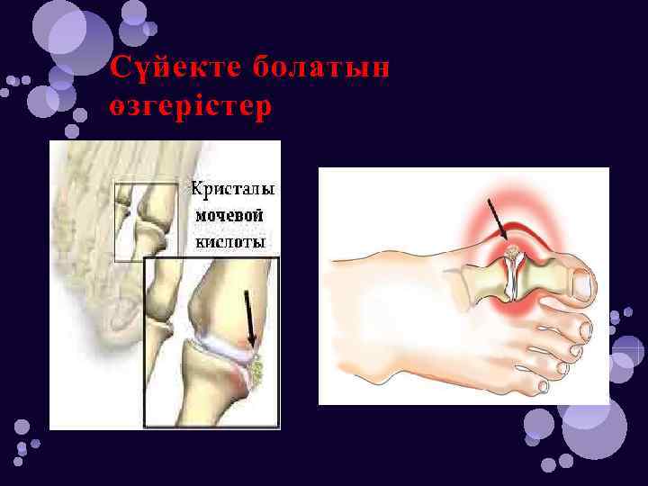 Сүйекте болатын өзгерістер 