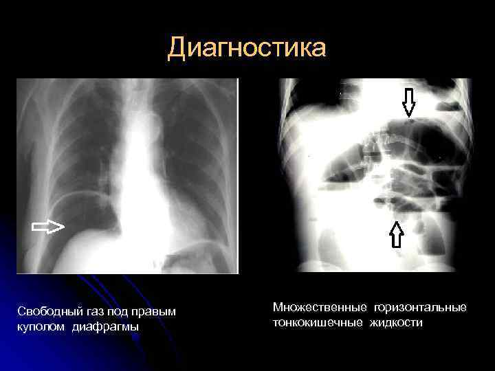 Диагностика Свободный газ под правым куполом диафрагмы Множественные горизонтальные тонкокишечные жидкости 