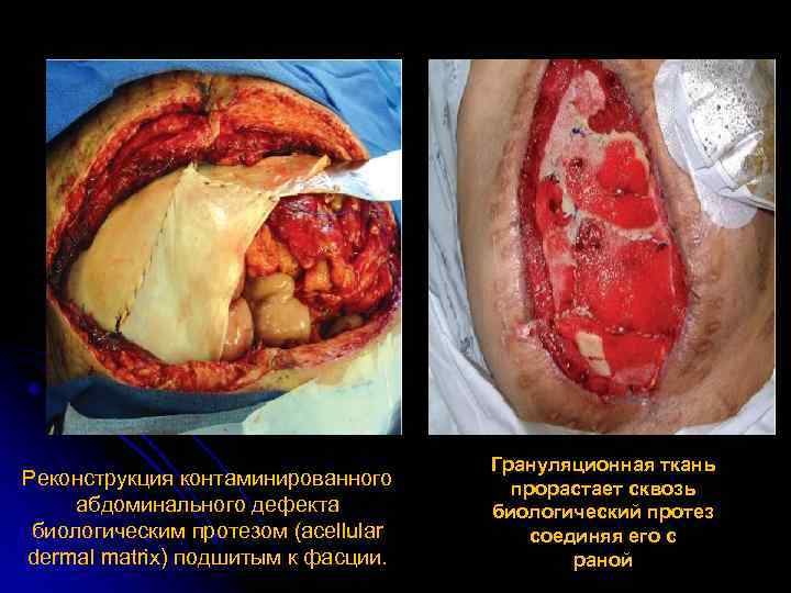 Реконструкция контаминированного абдоминального дефекта биологическим протезом (acellular dermal matrix) подшитым к фасции. Грануляционная ткань