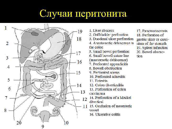 Случаи перитонита 