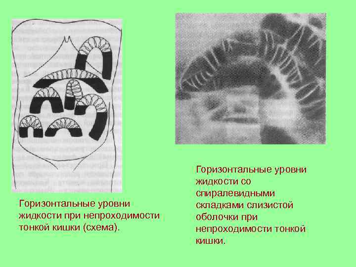 Горизонтальные уровни жидкости при непроходимости тонкой кишки (схема). Горизонтальные уровни жидкости со спиралевидными складками