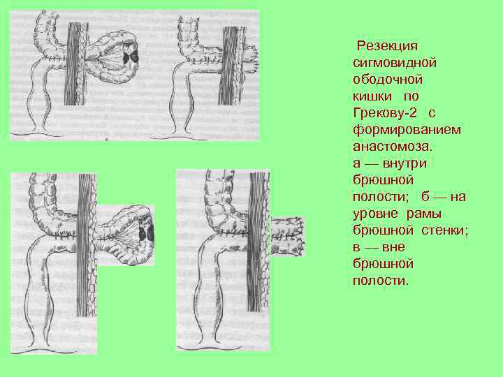 Резекция сигмовидной ободочной кишки по Грекову-2 с формированием анастомоза. а — внутри брюшной полости;