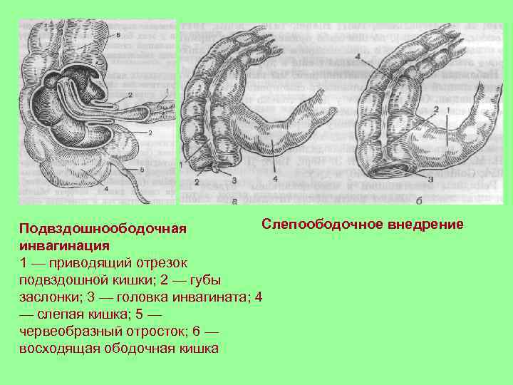 Слепоободочное внедрение Подвздошноободочная инвагинация 1 — приводящий отрезок подвздошной кишки; 2 — губы заслонки;