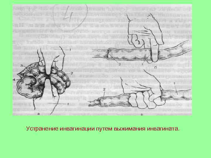 Устранение инвагинации путем выжимания инвагината. 