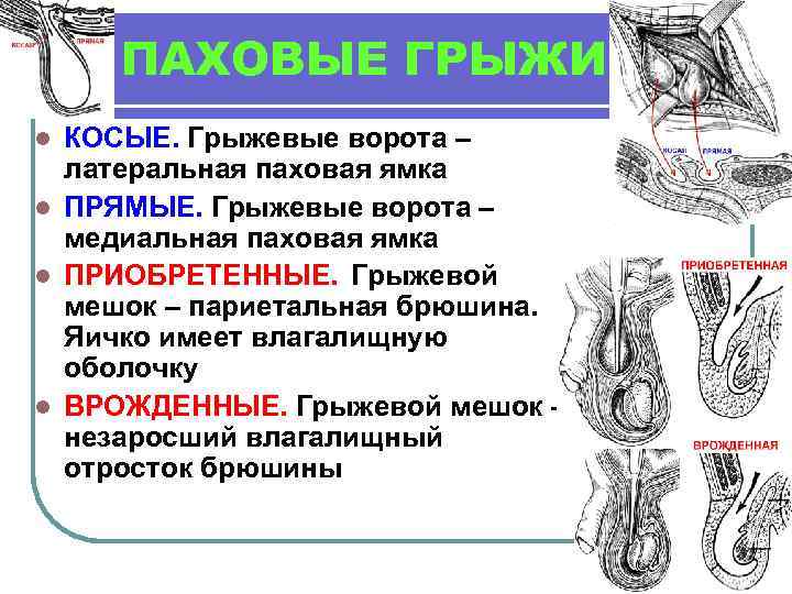 ПАХОВЫЕ ГРЫЖИ КОСЫЕ. Грыжевые ворота – латеральная паховая ямка l ПРЯМЫЕ. Грыжевые ворота –