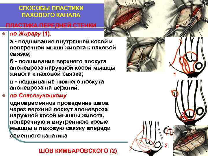 СПОСОБЫ ПЛАСТИКИ ПАХОВОГО КАНАЛА ПЛАСТИКА ПЕРЕДНЕЙ СТЕНКИ l по Жирару (1). а - подшивание