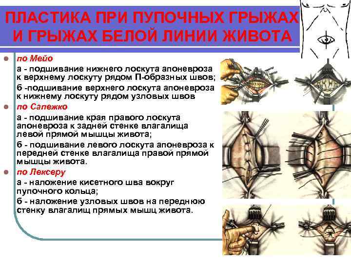 ПЛАСТИКА ПРИ ПУПОЧНЫХ ГРЫЖАХ И ГРЫЖАХ БЕЛОЙ ЛИНИИ ЖИВОТА по Мейо а - подшивание