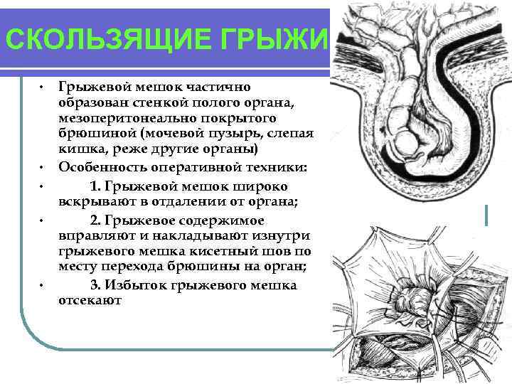 СКОЛЬЗЯЩИЕ ГРЫЖИ • • • Грыжевой мешок частично образован стенкой полого органа, мезоперитонеально покрытого
