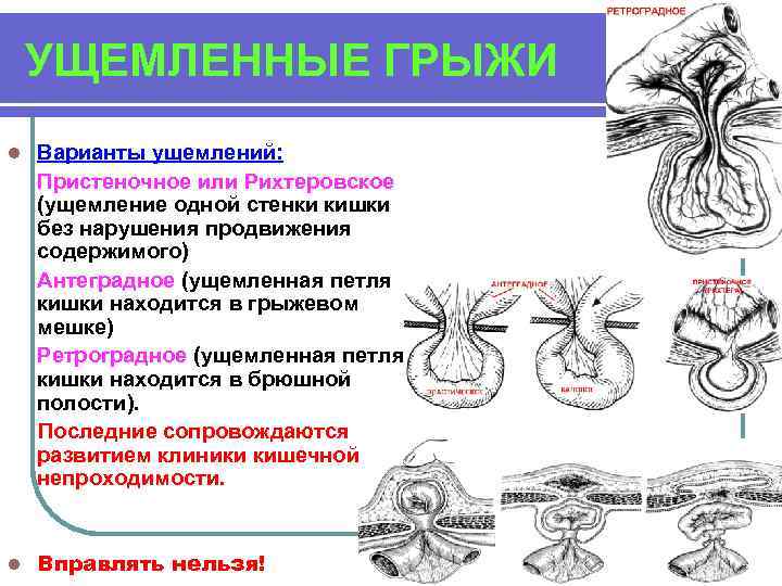 УЩЕМЛЕННЫЕ ГРЫЖИ l Варианты ущемлений: Пристеночное или Рихтеровское (ущемление одной стенки кишки без нарушения