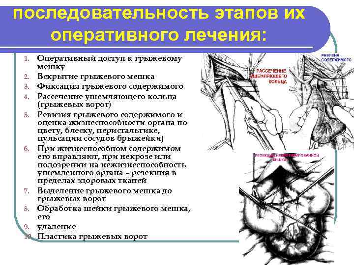 Какую стенку бедренного кольца рассекают при ущемленной бедренной грыже