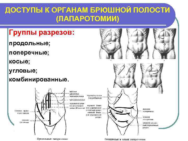 ДОСТУПЫ К ОРГАНАМ БРЮШНОЙ ПОЛОСТИ (ЛАПАРОТОМИИ) Группы разрезов: продольные; поперечные; косые; угловые; комбинированные. 
