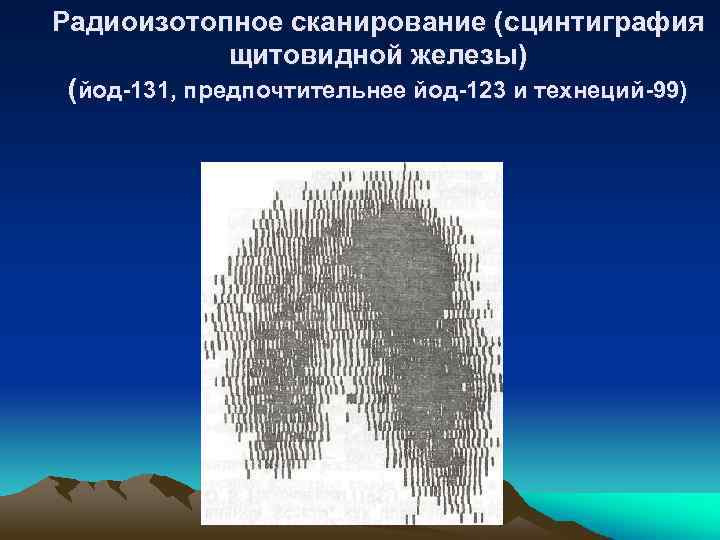 Радиоизотопное сканирование (сцинтиграфия щитовидной железы) (йод-131, предпочтительнее йод-123 и технеций-99) 