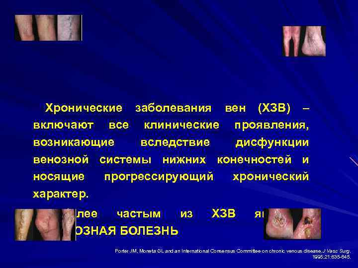 “Хронические заболевания вен (ХЗВ) – включают все клинические проявления, возникающие вследствие дисфункции венозной системы