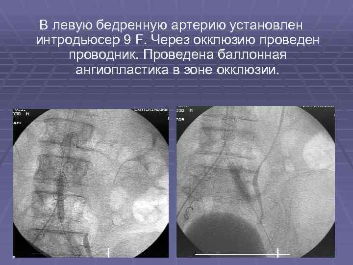В левую бедренную артерию установлен интродьюсер 9 F. Через окклюзию проведен проводник. Проведена баллонная