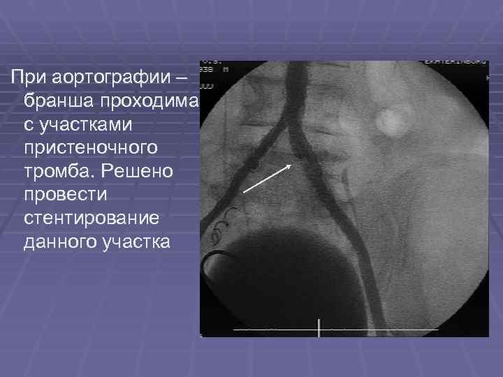  При аортографии – бранша проходима с участками пристеночного тромба. Решено провести стентирование данного