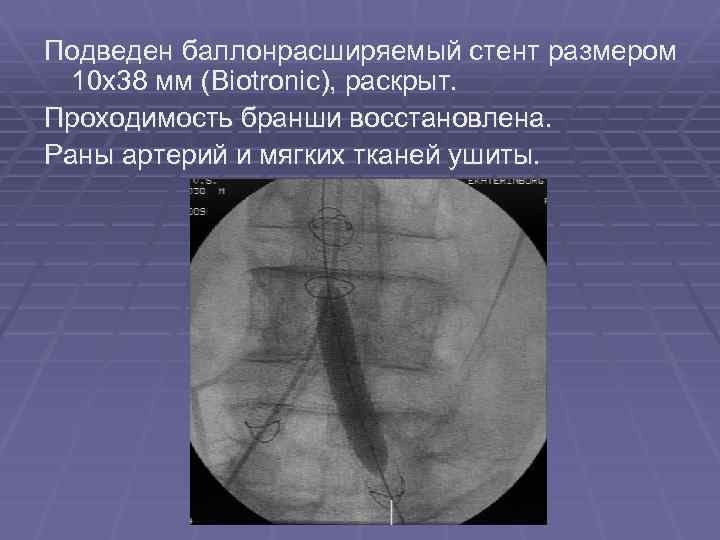 Подведен баллонрасширяемый стент размером 10 х38 мм (Biotronic), раскрыт. Проходимость бранши восстановлена. Раны артерий