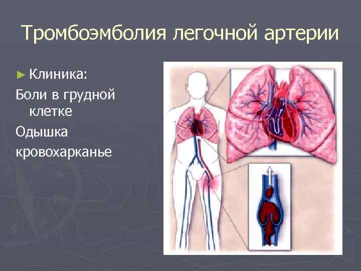 Тромбоэмболия легочной артерии ► Клиника: Боли в грудной клетке Одышка кровохарканье 