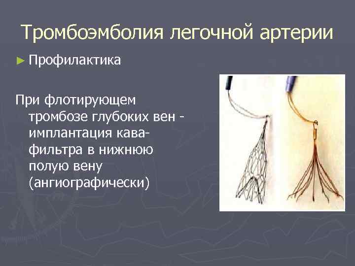 Тромбоэмболия легочной артерии ► Профилактика При флотирующем тромбозе глубоких вен имплантация кавафильтра в нижнюю