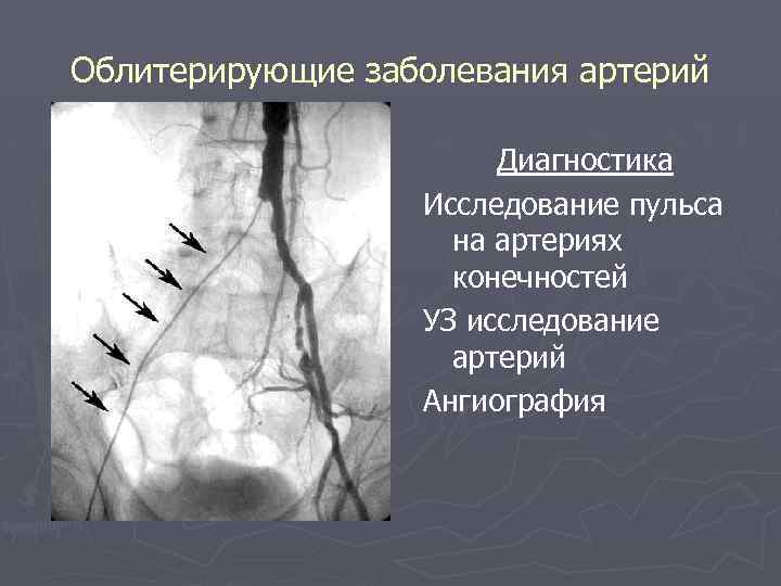 Облитерирующие заболевания артерий Диагностика Исследование пульса на артериях конечностей УЗ исследование артерий Ангиография 