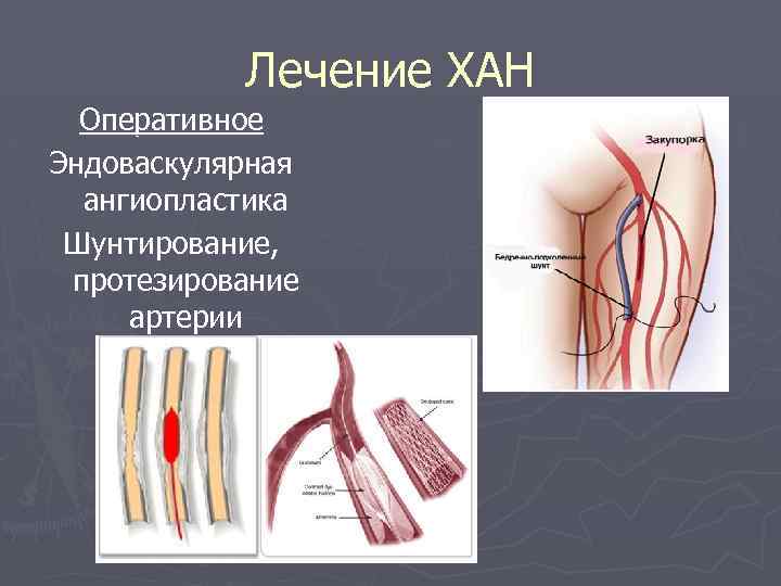 Лечение ХАН Оперативное Эндоваскулярная ангиопластика Шунтирование, протезирование артерии 