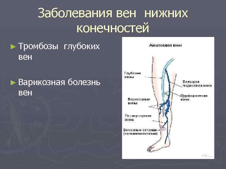 Заболевания вен нижних конечностей ► Тромбозы вен глубоких ► Варикозная вен болезнь 