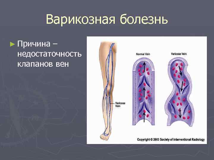 Варикозная болезнь ► Причина – недостаточность клапанов вен 
