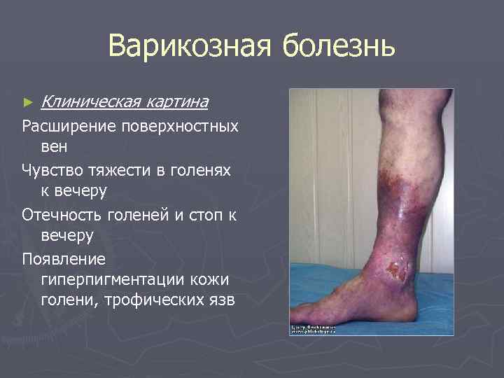 Варикозная болезнь ► Клиническая картина Расширение поверхностных вен Чувство тяжести в голенях к вечеру
