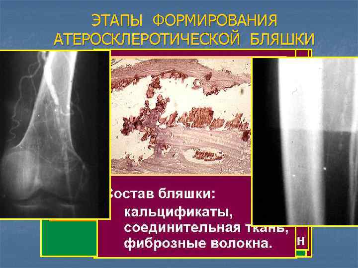 ЭТАПЫ ФОРМИРОВАНИЯ АТЕРОСКЛЕРОТИЧЕСКОЙ БЛЯШКИ 1. Повреждение эндотелия 2. Проникновение липидов в стенку сосуда –