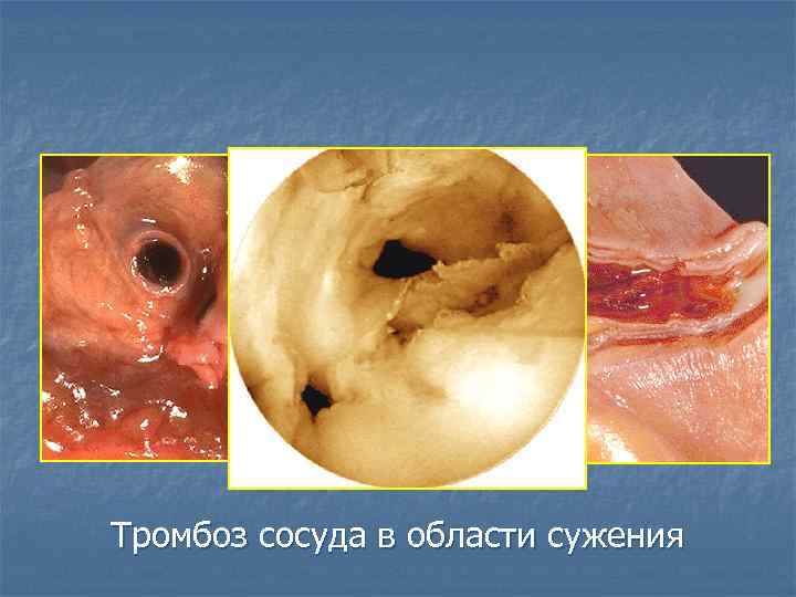 Тромбоз сосуда в области сужения 