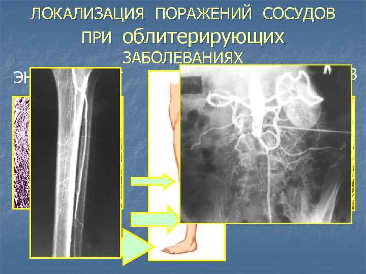 ЛОКАЛИЗАЦИЯ ПОРАЖЕНИЙ СОСУДОВ ПРИ облитерирующих ЗАБОЛЕВАНИЯХ АТЕРОСКЛЕРОЗ ЭНДАРТЕРИИТ 