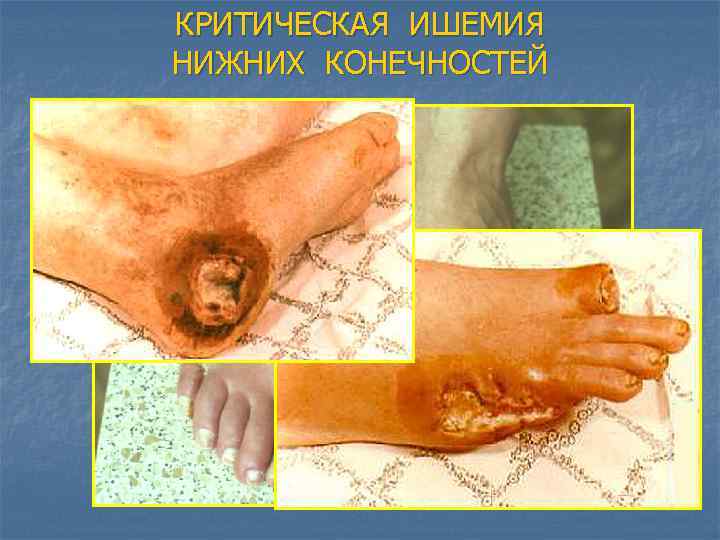 КРИТИЧЕСКАЯ ИШЕМИЯ НИЖНИХ КОНЕЧНОСТЕЙ 