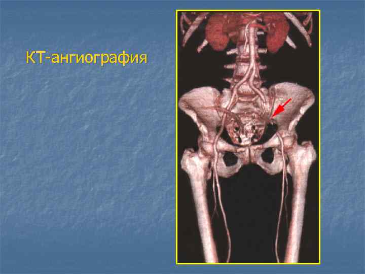 КТ-ангиография 