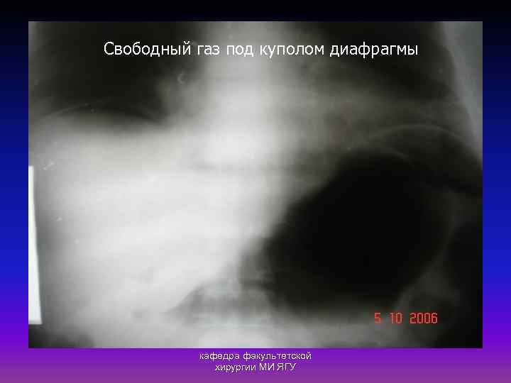 Свободный газ под куполом диафрагмы кафедра факультетской хирургии МИ ЯГУ 