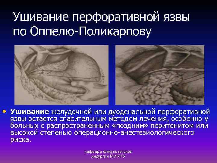 Ушивание перфоративной язвы по Оппелю-Поликарпову • Ушивание желудочной или дуоденальной перфоративной язвы остается спасительным