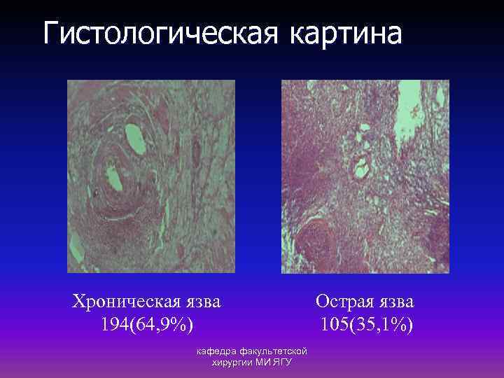 Гистологическая картина Хроническая язва 194(64, 9%) кафедра факультетской хирургии МИ ЯГУ Острая язва 105(35,